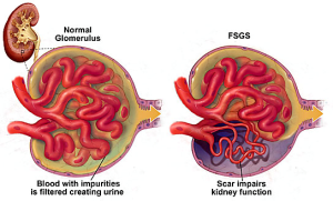Ochratoxin A causes Focal Segmental Glomerulosclerosis (FSGS)